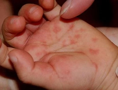 Συναγερμός σε παιδικό σταθμό – Εμφανίστηκε κρούσμα του ιού Κοξάκι